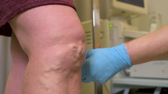 a vascular surgeon or phlebologist makes an ultrasound of varicose veins on the legs of a female patient.