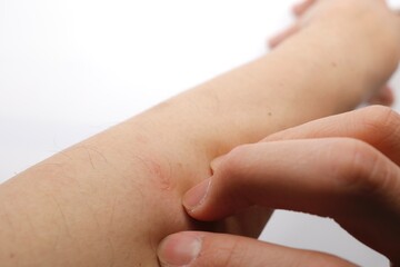 腕を掻く　赤みがかった腕の一部