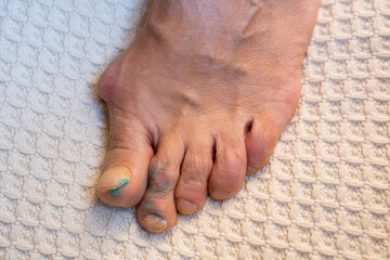 inflamed and deformed joints on the toes due to arthritis or gout.