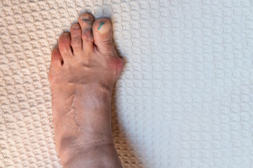 deformed big toe with a protruding bone. rheumatoid arthritis or gout affects the toes of middle-aged caucasian woman.