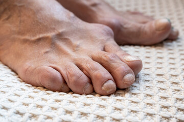 warped, cracked and scratched nails on the feet of an elderly woman, close-up, selective focus. deficiency of vitamins and minerals, which leads to problems with nails and skin.