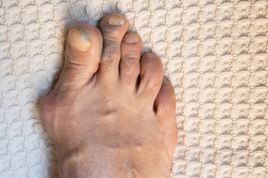 inflamed and deformed joints on the leg. gouty toes. toes affected by Gout.