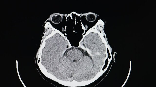 CT cine scan of a patient with weakness of legs showing severe brain atrophy with lacuna infarction involving bilateral lentiform neucleus in the brain.