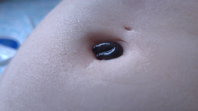 Hirudo medicinalis are widely used all around the world today and in the past in healing, rejuvenation, cure diseases in organs. They thin blood with saliva, sucking out infected and dirty lymph