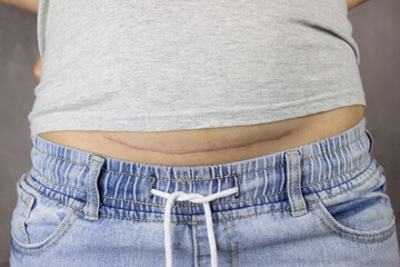 girl with the cesarean scar on her stomach