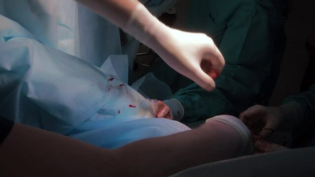 Surgeons use medical instruments to suture human skin during proctological minimally invasive surgery on the anus. Close-up of hands in sterile gloves, covered with blood. Blue uniform and masks.