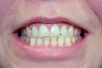 female smile close up. female lips without lipstick. human teeth