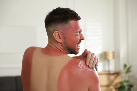 Man applying cream on sunburn at home, back view