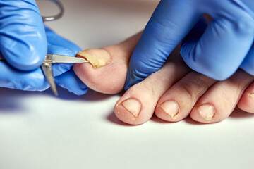The toenail is affected by the fungus. Nail fungus treatment.