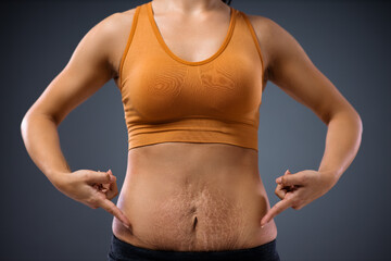 Young mum standing and pointing at her belly full of stretch marks after pregnancy.