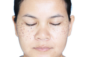 Face of ASEAN women That has signs of laser freckle removal On her face. The concept of skin...