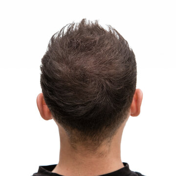 Halbglatze eines Mannes mit Haarausfall	von hinten nach einer Haarbehandlung