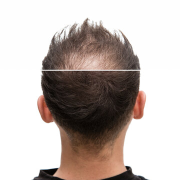 Vorher Nachher - Halbglatze eines Mannes mit Haarausfall	von hinten