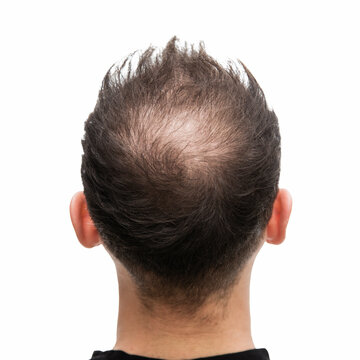 Halbglatze eines Mannes mit Haarausfall	von hinten