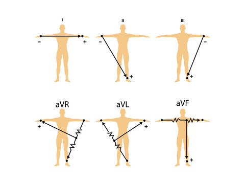 Einthoven ECG Triangle, Including Augmented Unipolar Limb Lead