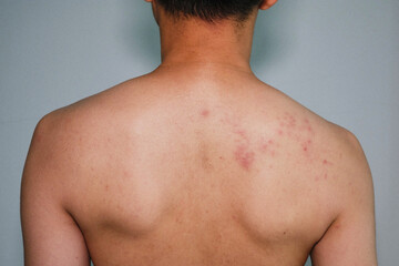 Fototapeta premium Shingles, Zoster or Herpes Zoster symptoms ,Wound is healed and starts to dry out