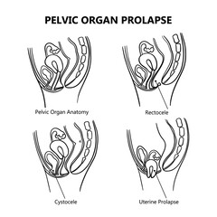 PELVIC ORGAN PROLAPSE VARIOUSLY MONOCHROME Of Women General Diagram With Explanatory Text For Medical Education Clip Art Vector Illustration Set For Print