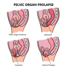 PELVIC ORGAN PROLAPSE VARIOUSLY Of Women General Diagram With Explanatory Text For Medical Education Clip Art Vector Illustration Set For Print