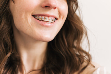 smile teeth braces system