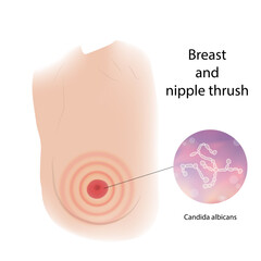 Woman breast and nipple thrush infection view with description. Candida albicans. Medical vector illustration.