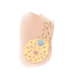 Woman breast disorders. Cyst. Medical vector illustration.