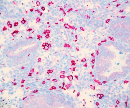 Endometrium tissue infiltrated by numerous natural killer cells which cause infertility. The cells are red with this CD 56 stain. Microscopic view.