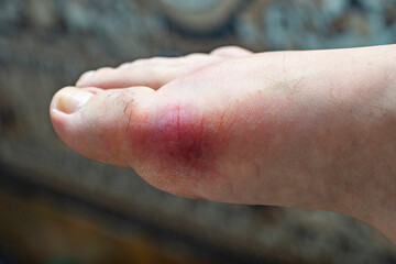 Large hematoma on the leg from a swollen joint