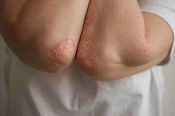 psoriasis on the skin of the elbow of a young woman in a white T-shirt. close-up