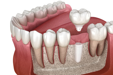 Molar tooth crown installation over ceramic implant. Medically accurate 3D illustration of dental implantation