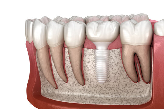 Molar tooth crown installation over ceramic implant. Medically accurate 3D illustration of dental implantation