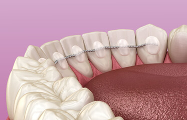 Fototapeta na wymiar Retainers dental installed after braces treatment, Medically accurate dental 3D illustration