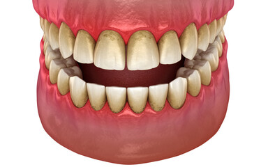 Tartar and bactrail tooth plaque, jaw inflammation. Medically accurate 3D illustration of human teeth treatment