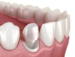 Stump pin tab on canaine tooth. Medically accurate dental 3D illustration