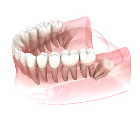 Distal impaction of Wisdom tooth. Medically accurate tooth 3D illustration