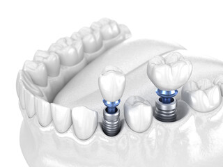 Premolar and Molar tooth crown installation over implant - white concept. 3D illustration of human teeth and dentures