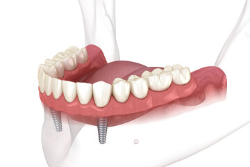 Mandibular removable prosthesis All on 2 system supported by implants with ball attachments. Medically accurate dental 3D illustration