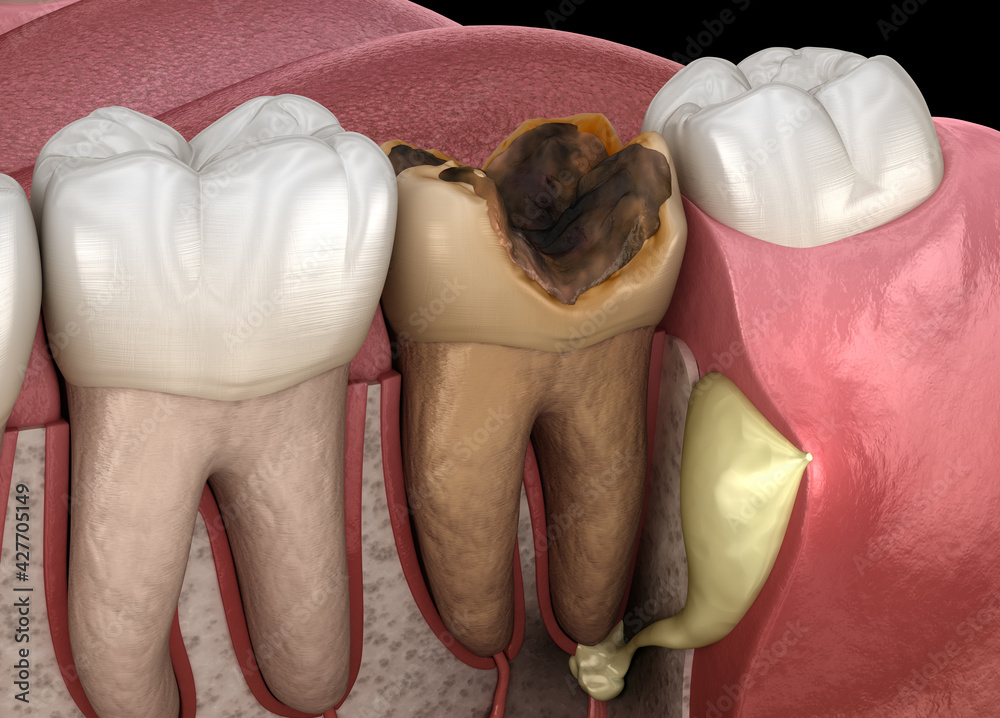 Wall mural Periostitis tooth - Lump on Gum Above Tooth. Medically accurate dental 3D illustration - Wall murals