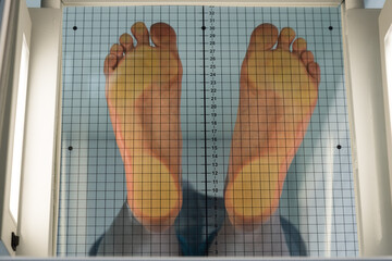 The patient stands on a special apparatus for determining flat feet. the orthopedic surgeon evaluates the load distribution of the feet. Determination of the type of flat feet. Determination of the