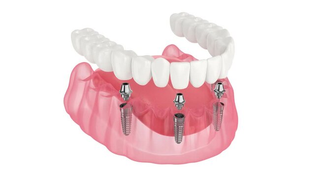 Mandibular prosthesis all on 4system supported by implants