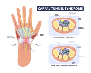 Carpal Tunnel Syndrome pain hand arm wrist splint surgery bone flexor fingers thumb muscle Brace index middle ring work limb palm mouse keyboard