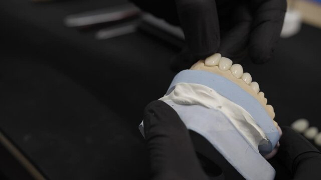 Installation of veneers on the jaw