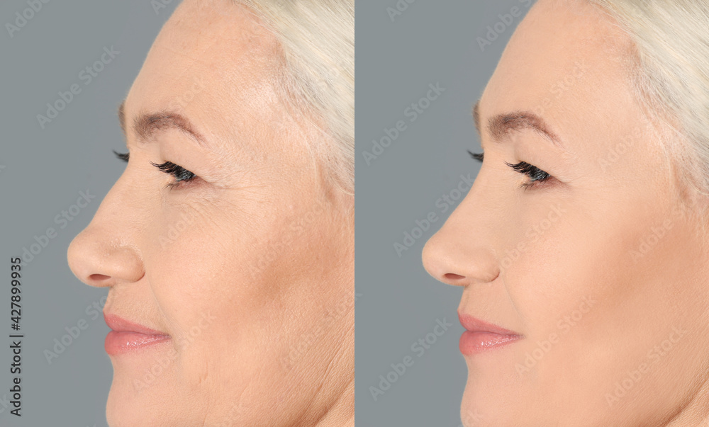 Sticker Collage with photos of mature woman before and after biorevitalization procedure on grey background