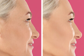 Obraz premium Collage with photos of mature woman before and after biorevitalization procedure on pink background, closeup