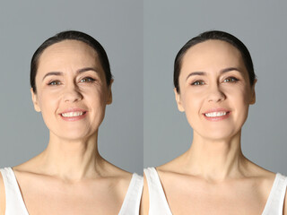Beautiful mature woman before and after cosmetic procedure on grey background, collage. Plastic surgery