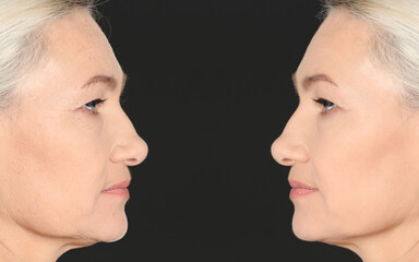 Beautiful mature woman before and after cosmetic procedure on black background, collage. Plastic surgery
