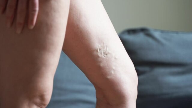 Varicose vein close up leg. Senior woman health problem. Foot with Diseased Veins. Health Care, Podiatry.