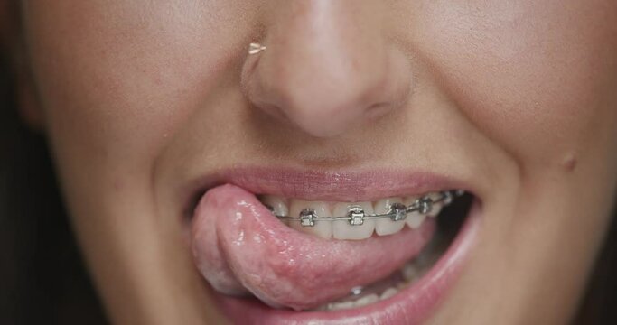 Teeth alignment by braces. Close up young woman licks lips seductively with tongue. Dental care, orthodontic treatment