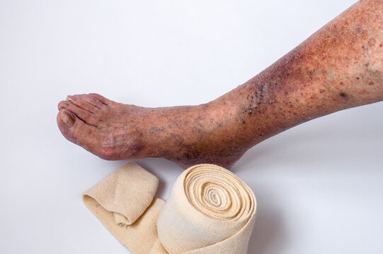 the leg of an elderly woman with varicose veins and its complications on a white background. Elastic bandage and compression treatment. Medical history. Thrombophlebitis