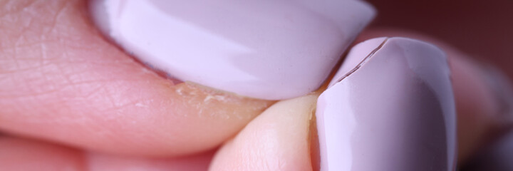 Close-up of female fingers with spoiled lilac manicure on nails