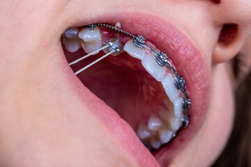 Close up of orthodontist hands putting elastic rubber band on patient brackets.